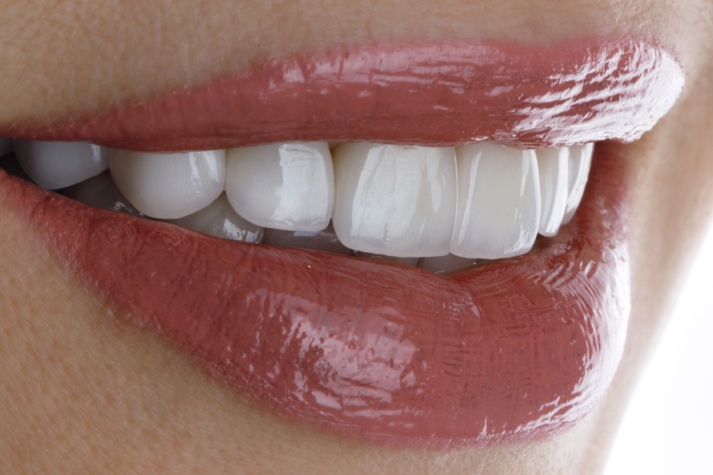 Veneer treatment in Kochi